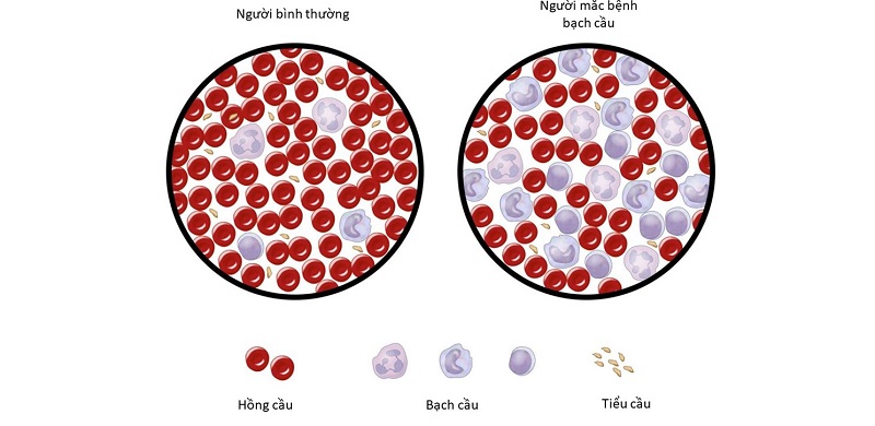 Hình ảnh minh họa tế bào bạch cầu tăng sinh bất thường trong CML