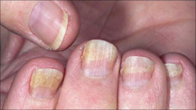 Móng bị tách khỏi nền - ảnh minh họa