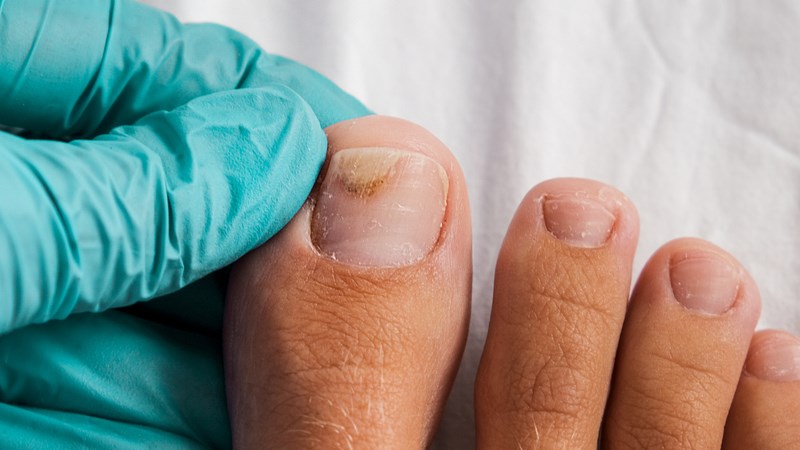 Chăm sóc móng bị tách đúng cách
