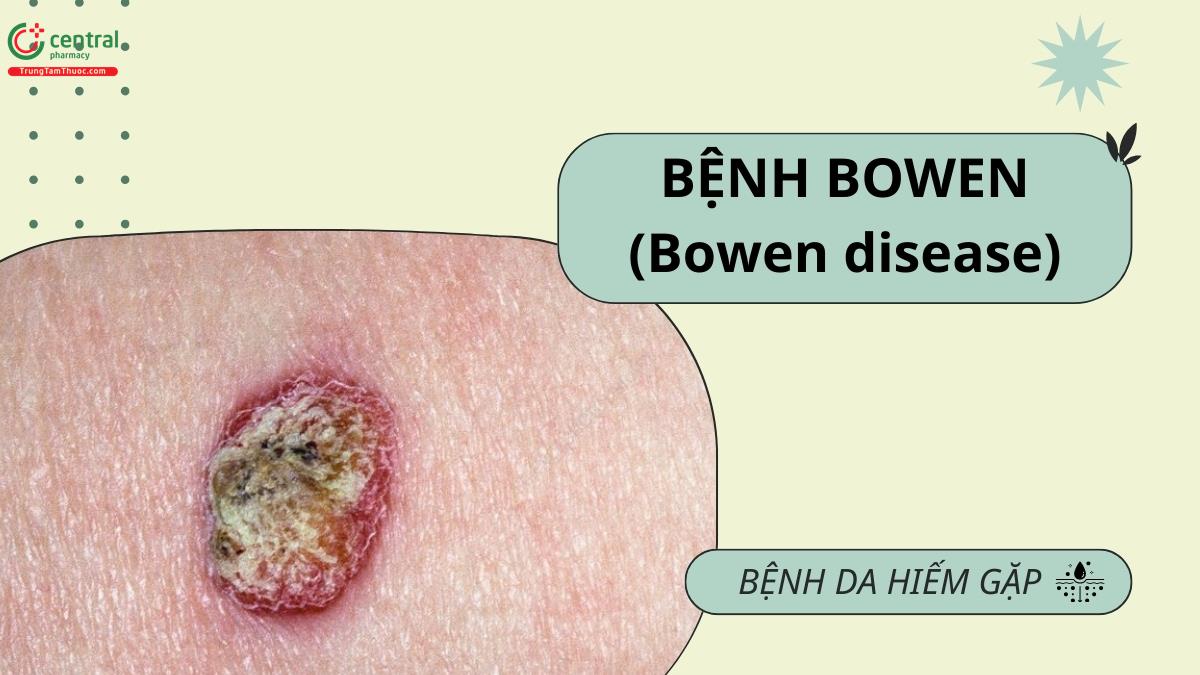 Hình ảnh bệnh Bowen trên da tay