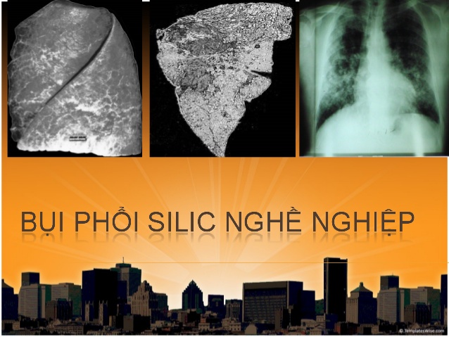 Bệnh bụi phổi silic là gì