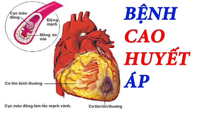 Đo huyết áp tại nhà để phát hiện sớm huyết áp cao
