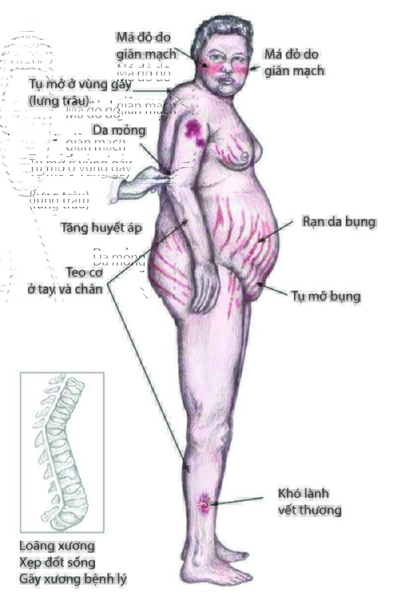 Triệu chứng hội chứng Cushing
