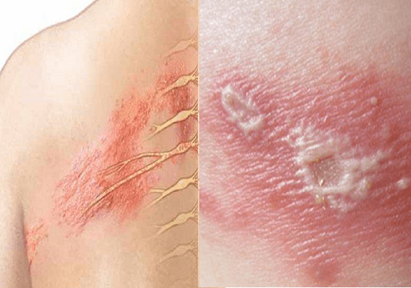 Bệnh do Bunyavirus: Những điều bạn cần biết để bảo vệ sức khỏe 8 Bệnh do Bunyavirus gây ra