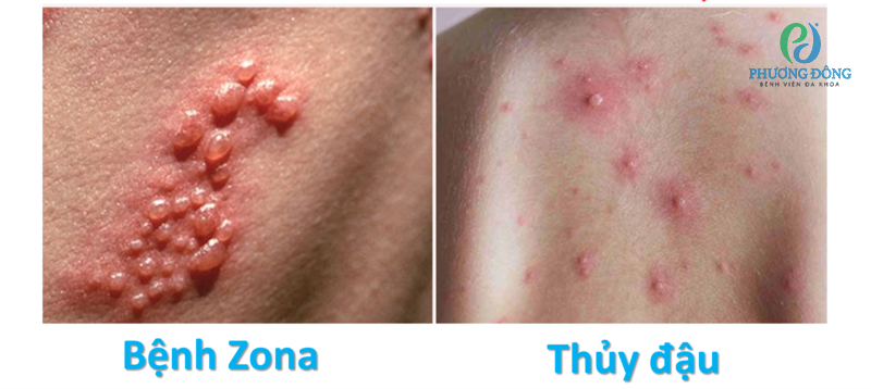 Nhiễm Herpes Simplex Virus (HSV) ở phổi: Nguy hiểm thầm lặng khó lường 8 Các bệnh do HSV gây ra