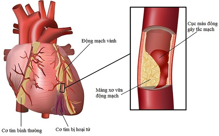 Hội Chứng Vành Cấp: Hiểu Đúng Để Điều Trị Kịp Thời 7 hội chứng vành cấp hình ảnh minh họa