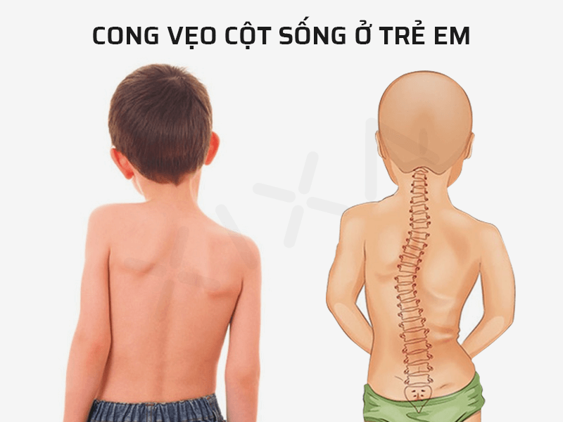 Gù cột sống ở trẻ nhỏ