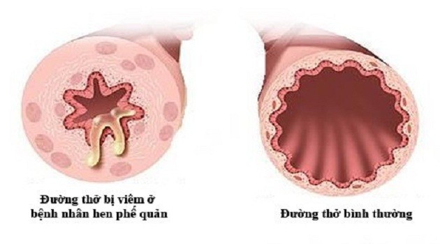 Hen phế quản dị ứng: Nguyên nhân, triệu chứng và cách điều trị hiệu quả 2 Hình ảnh minh họa đường hô hấp bị hen dị ứng