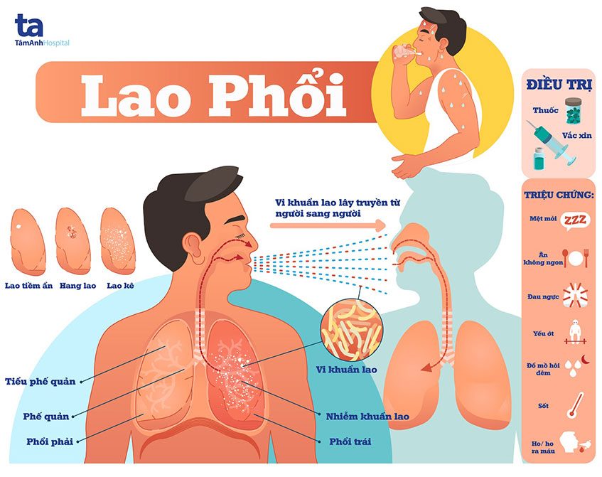 Triệu chứng lao phổi
