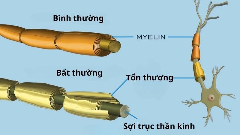 Triệu chứng hội chứng Guillain-Barré