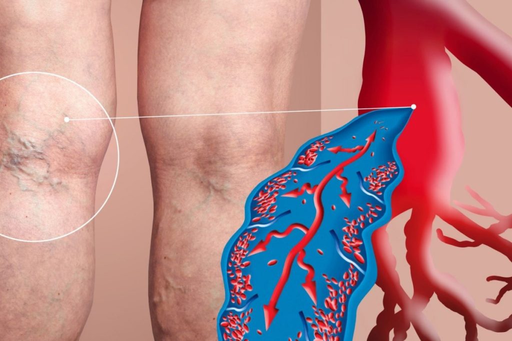 Huyết khối tĩnh mạch sâu (DVT): Hiểu đúng để phòng ngừa và điều trị hiệu quả 8 Phù một bên chân do DVT