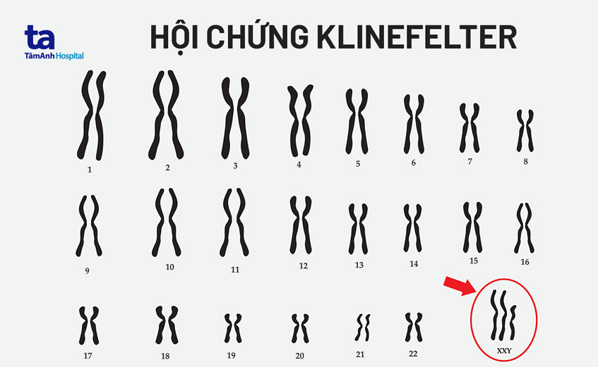 hoi-chung-klinefelter-nam
