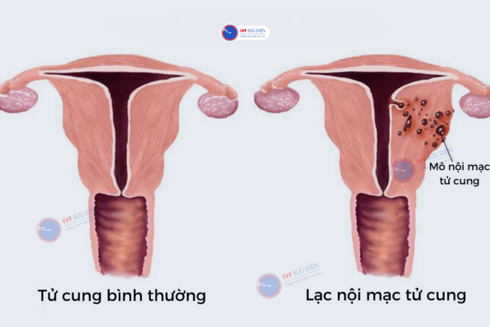 U lạc nội mạc tử cung ở buồng trứng: Nguyên nhân, triệu chứng và điều trị 8 Triệu chứng u lạc nội mạc tử cung