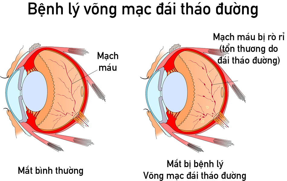 Phân loại bệnh võng mạc tiểu đường