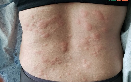 Mày Đay Do Áp Lực: Căn Bệnh Âm Thầm Gây Khó Chịu Lâu Dài 7 mày đay do áp lực
