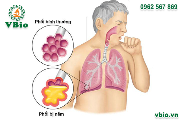 Ảnh minh họa tổn thương phổi do nấm