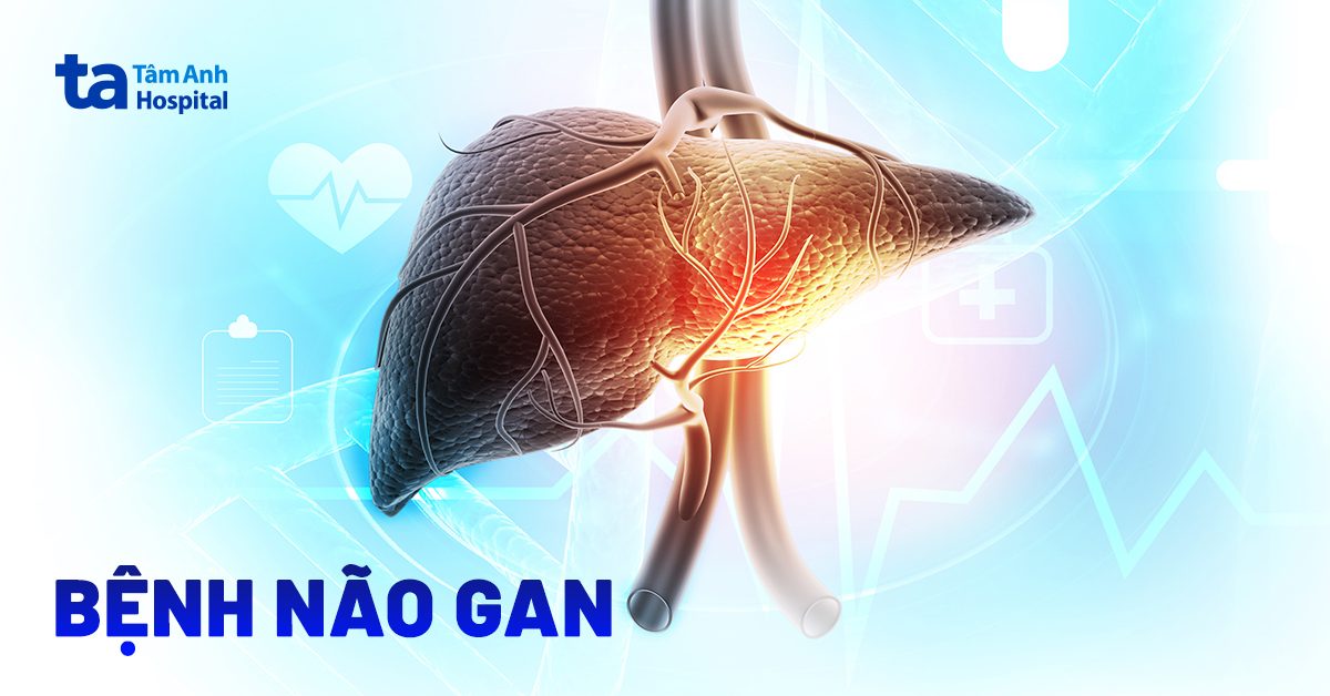 Biểu hiện thần kinh Wernicke