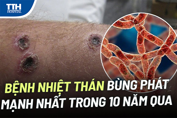 Bệnh than trên người và động vật