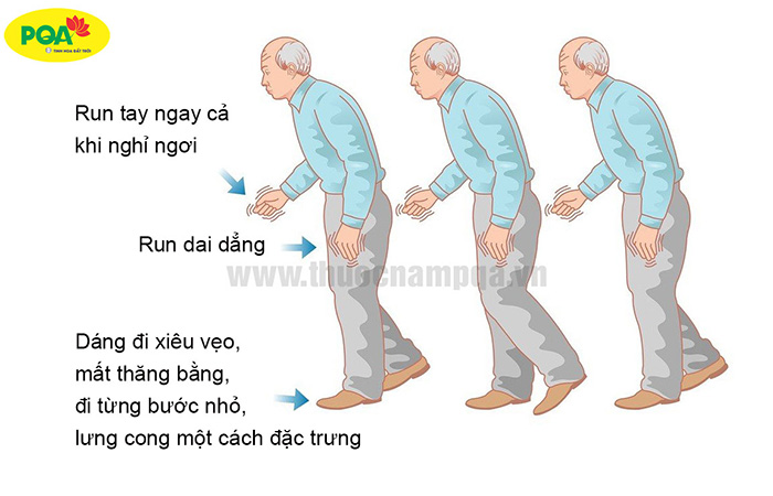 Run khi nghỉ do Parkinson