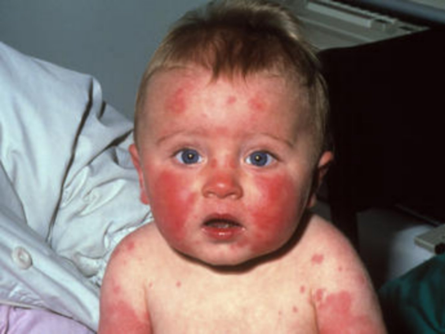 Nhiễm Parvovirus B19: Triệu chứng, nguyên nhân và cách điều trị 8 Nhiễm Parvovirus B19 trong thai kỳ có nguy hiểm