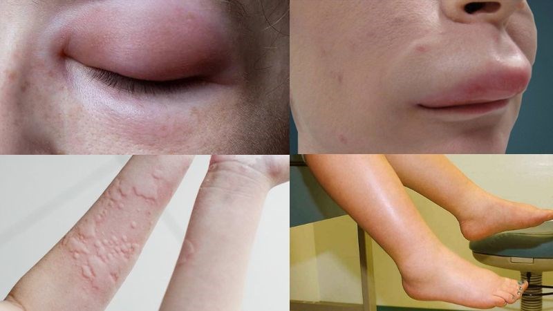 Phù mạch sưng da môi mí mắt