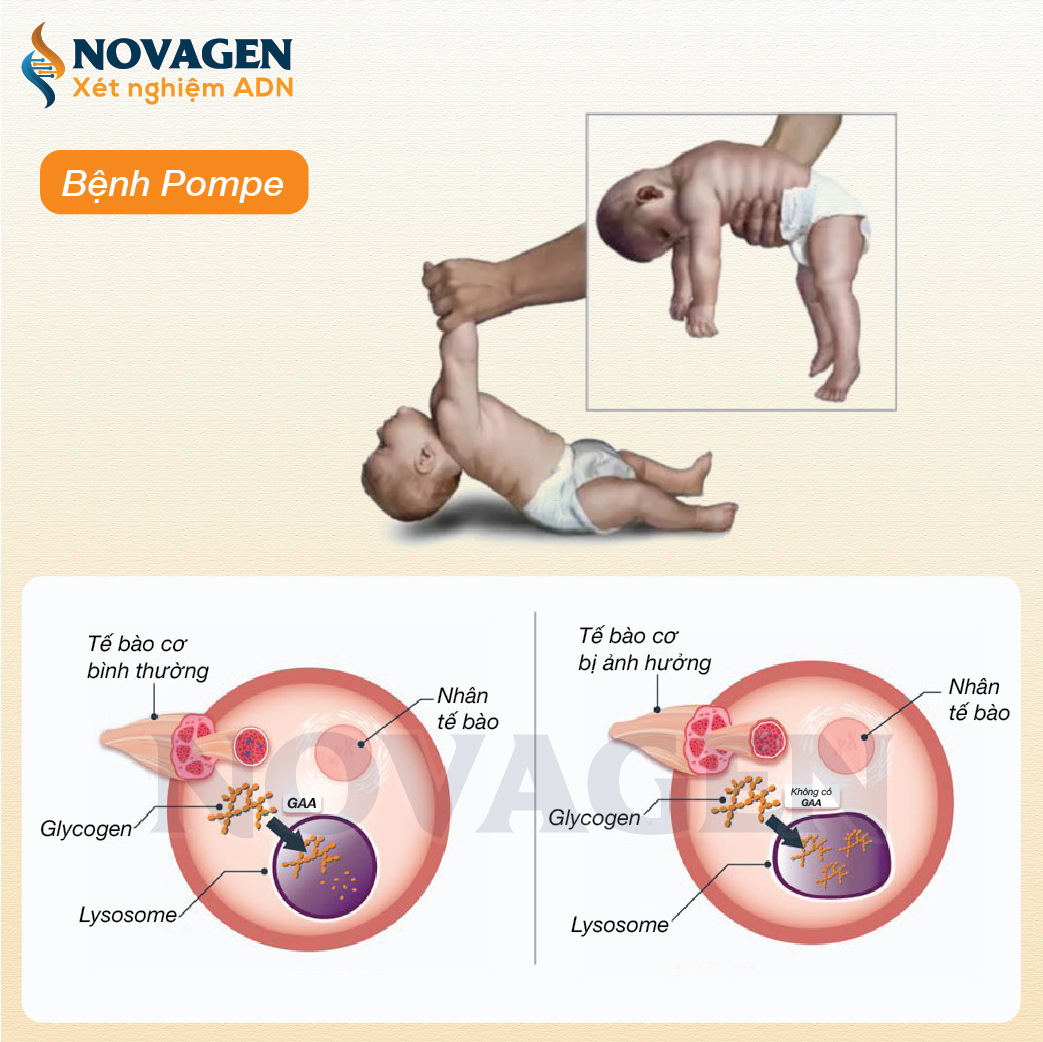 Hình ảnh minh họa bệnh Pompe