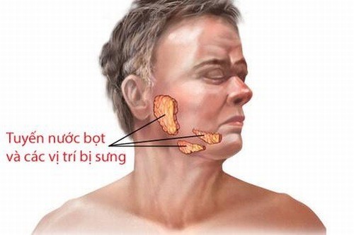 Nguyên nhân và biến chứng bệnh quai bị