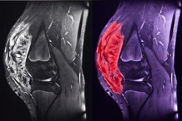 Phân loại sarcoma mô mềm