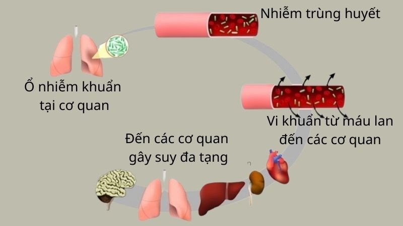 Sốc nhiễm khuẩn nguy hiểm