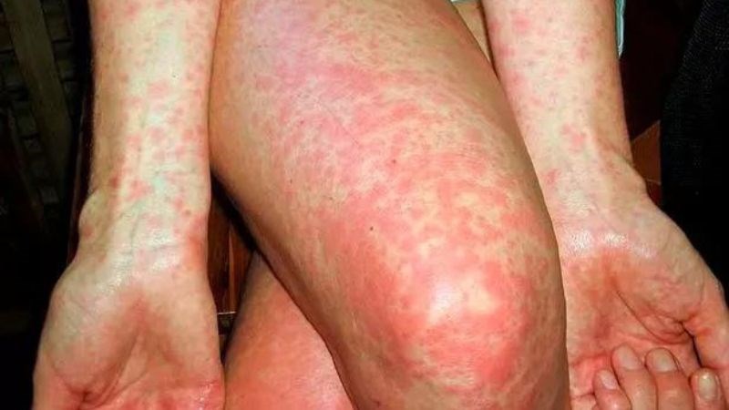 Trẻ em mắc sốt tinh hồng nhiệt