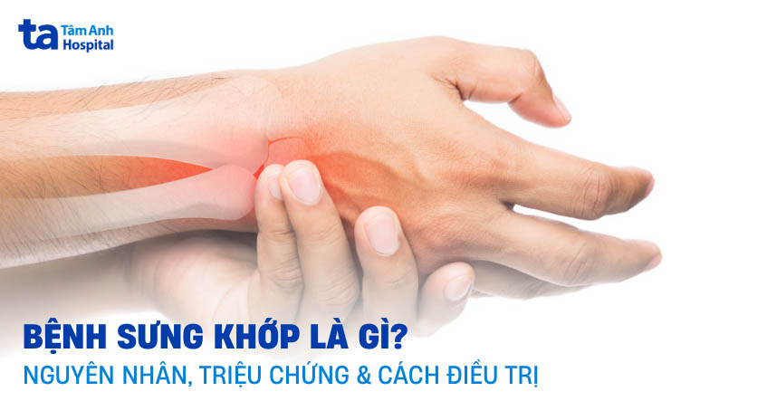 Bệnh sưng khớp là gì