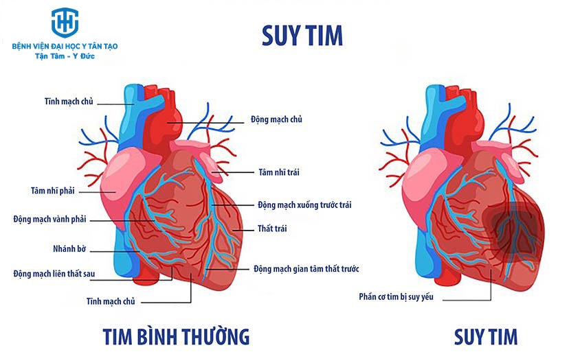 Suy tim mạn: Hiểu đúng để sống khỏe cùng trái tim yếu 8 Nguyên nhân gây suy tim mạn