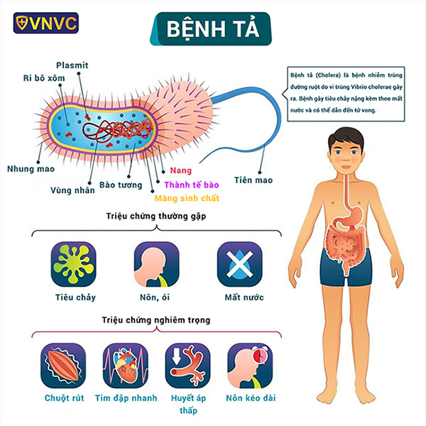 Triệu chứng bệnh tả ở trẻ em
