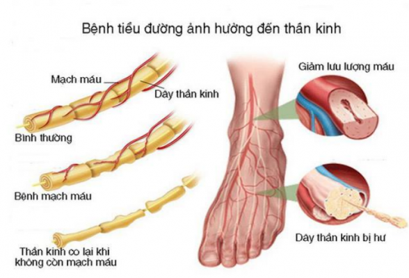 bệnh thần kinh tự chủ do đái tháo đường
