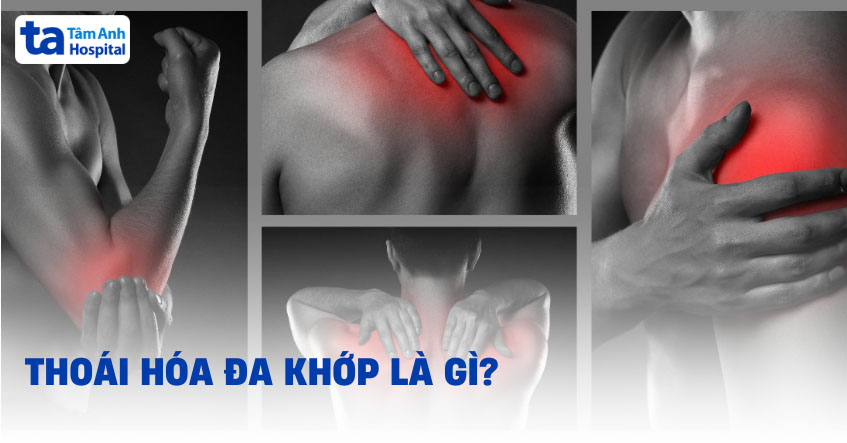 Thoái hóa đa khớp: Nguyên nhân, triệu chứng và cách điều trị hiệu quả 8 Nguyên nhân thoái hóa đa khớp