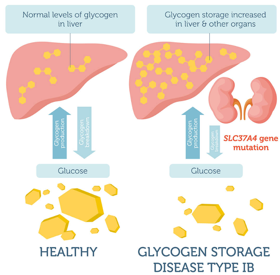 Bệnh tích lũy glycogen