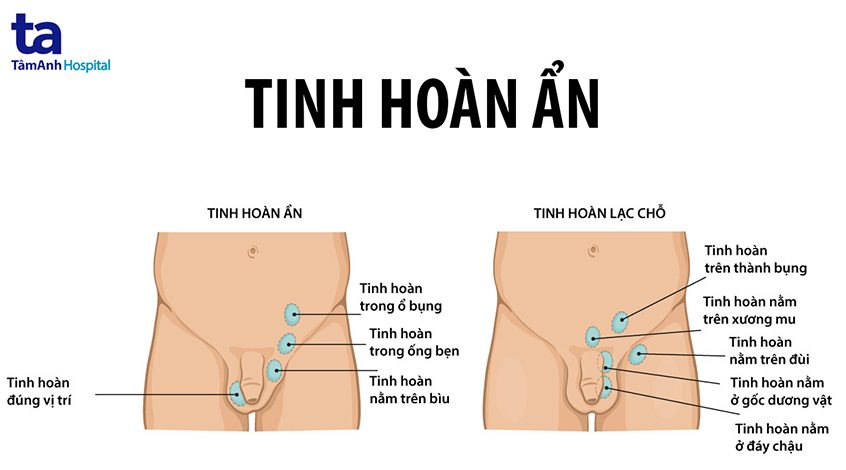 Tinh hoàn ẩn ở trẻ sơ sinh