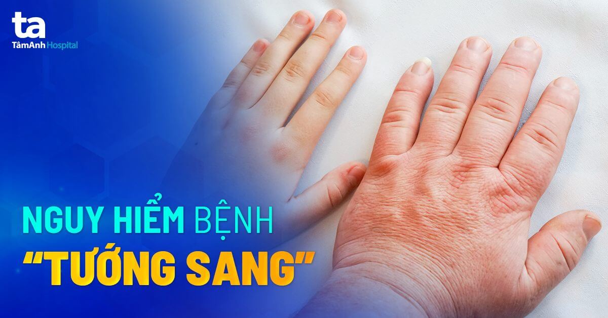 Hình ảnh bệnh nhân mắc bệnh to đầu chi