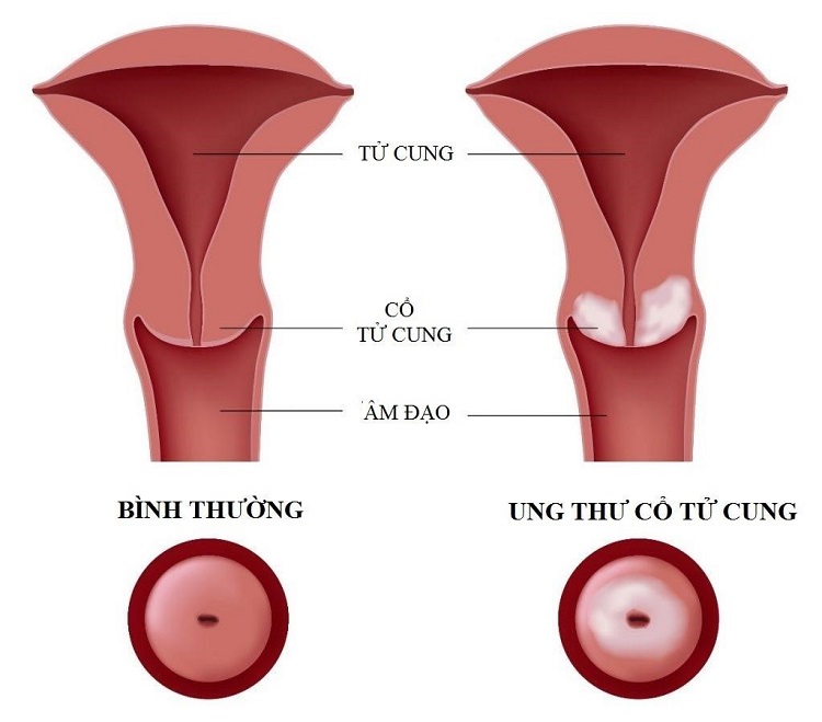 ung thư cổ tử cung là gì