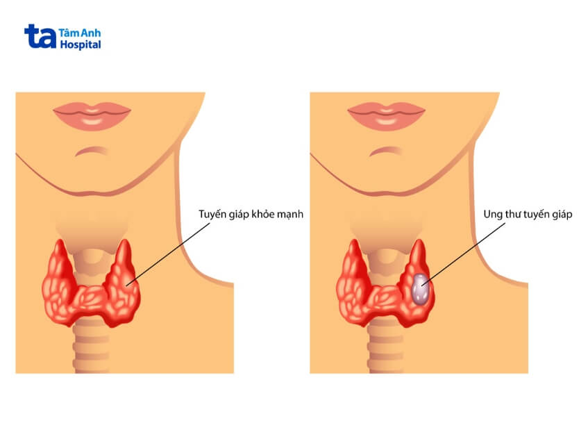 phẫu thuật điều trị ung thư tuyến giáp dạng tủy