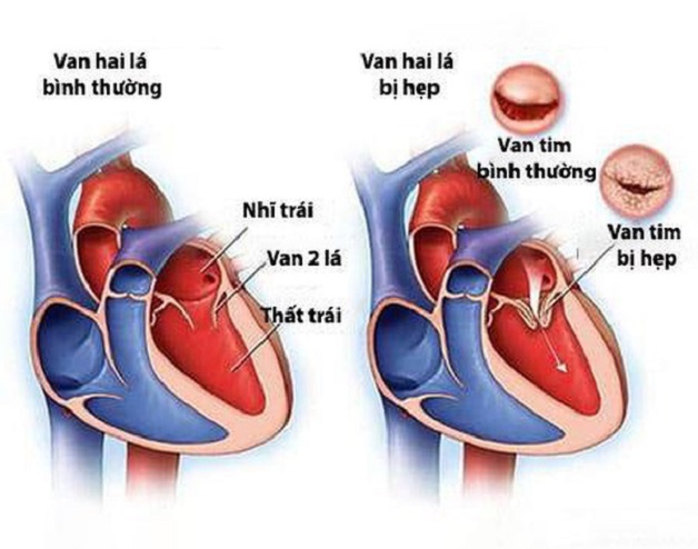 Hình ảnh van tim tổn thương do thấp