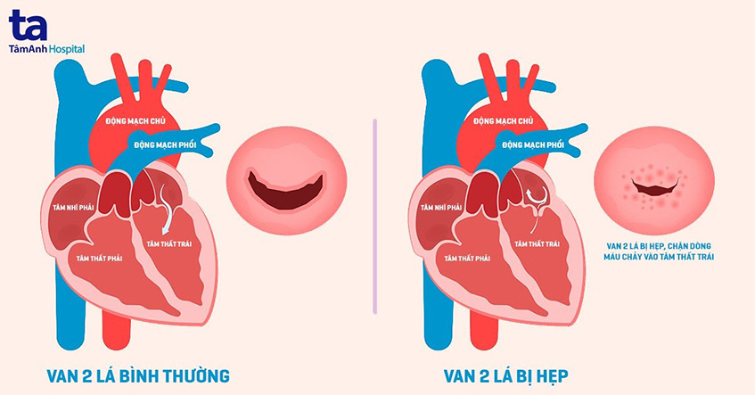 Thoái hóa van tim do tuổi già: Nguyên nhân, triệu chứng và hướng điều trị hiệu quả 4 Hình ảnh cấu tạo van tim