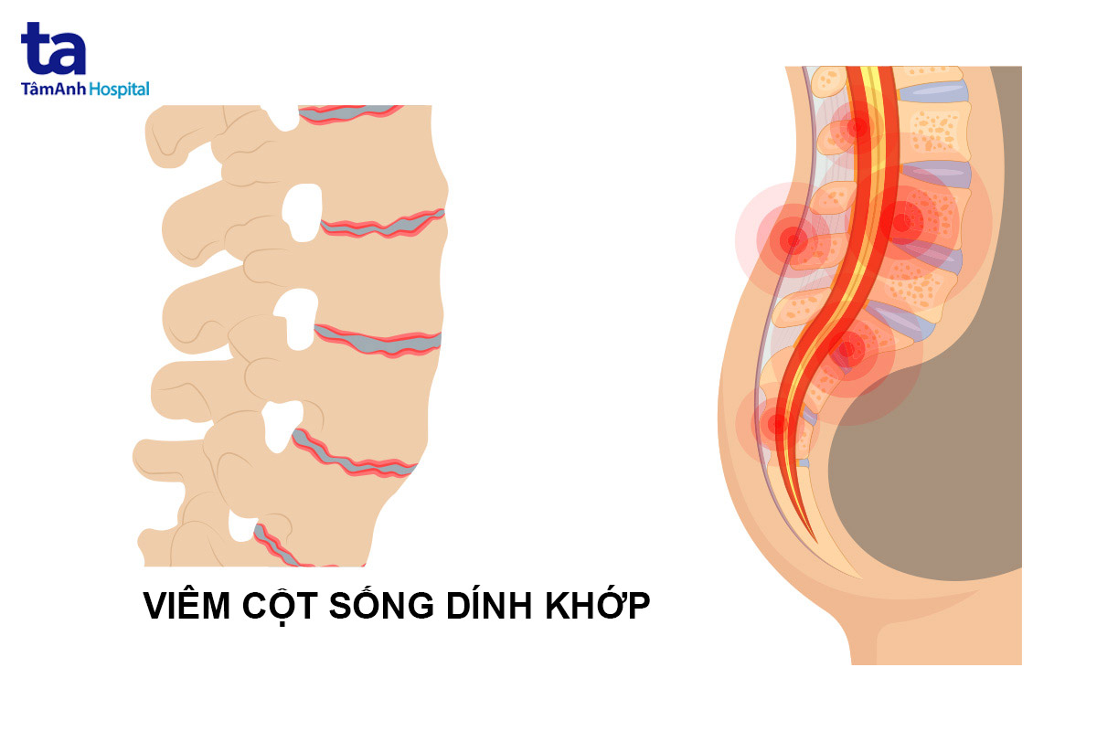 Viêm cột sống dính khớp là gì