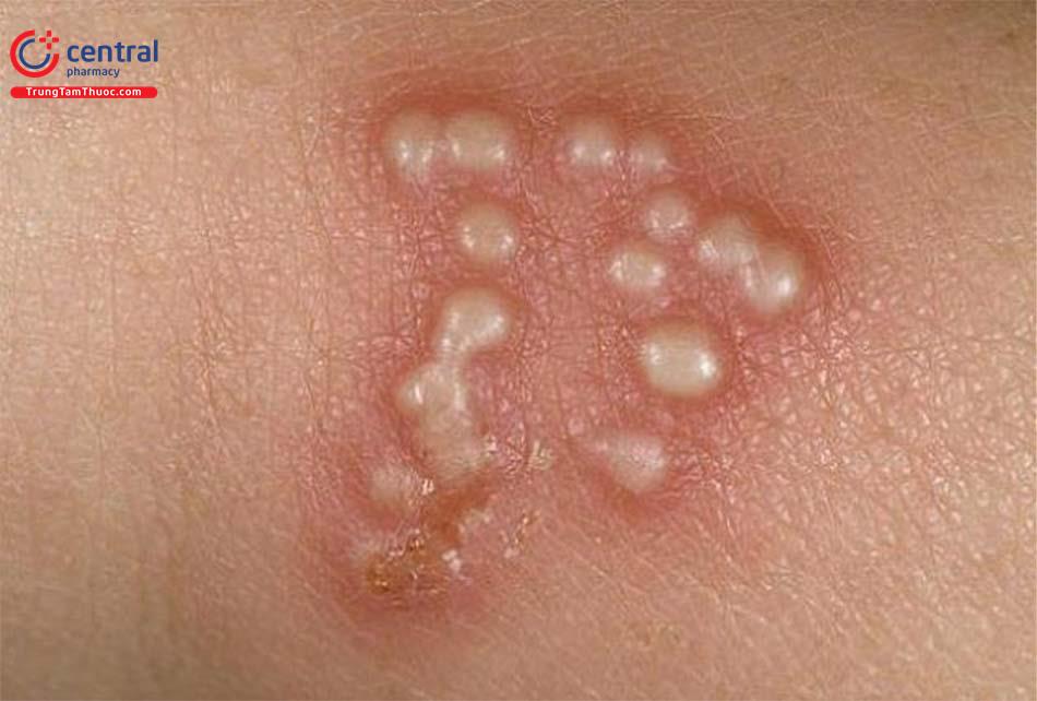 Viêm da dạng Herpes (Dermatitis Herpetiformis): Triệu chứng, nguyên nhân và điều trị 7 Hình ảnh viêm da dạng Herpes