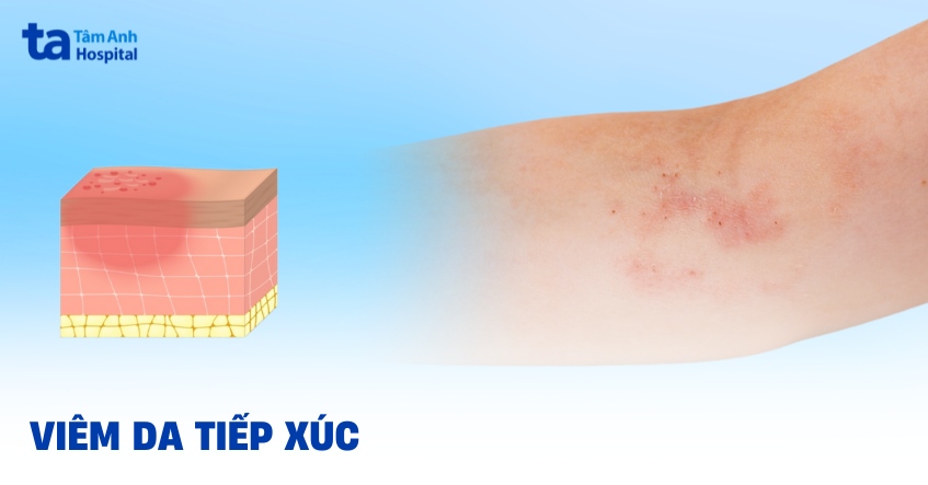 viem-da-tiep-xuc-la-gi