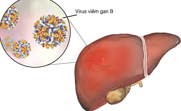 Triệu chứng viêm gan B