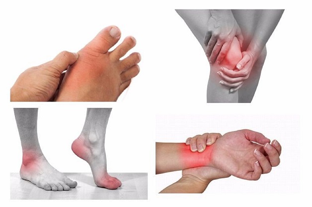viêm khớp cấp là gì