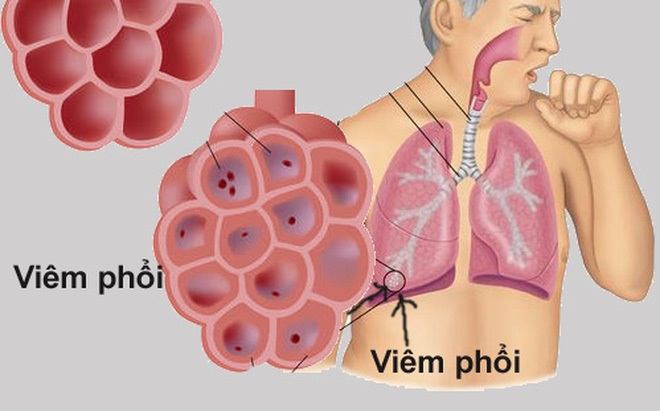 Viêm màng phổi do lupus: Hiểu đúng để điều trị hiệu quả 7 Hình ảnh minh họa viêm màng phổi do lupus