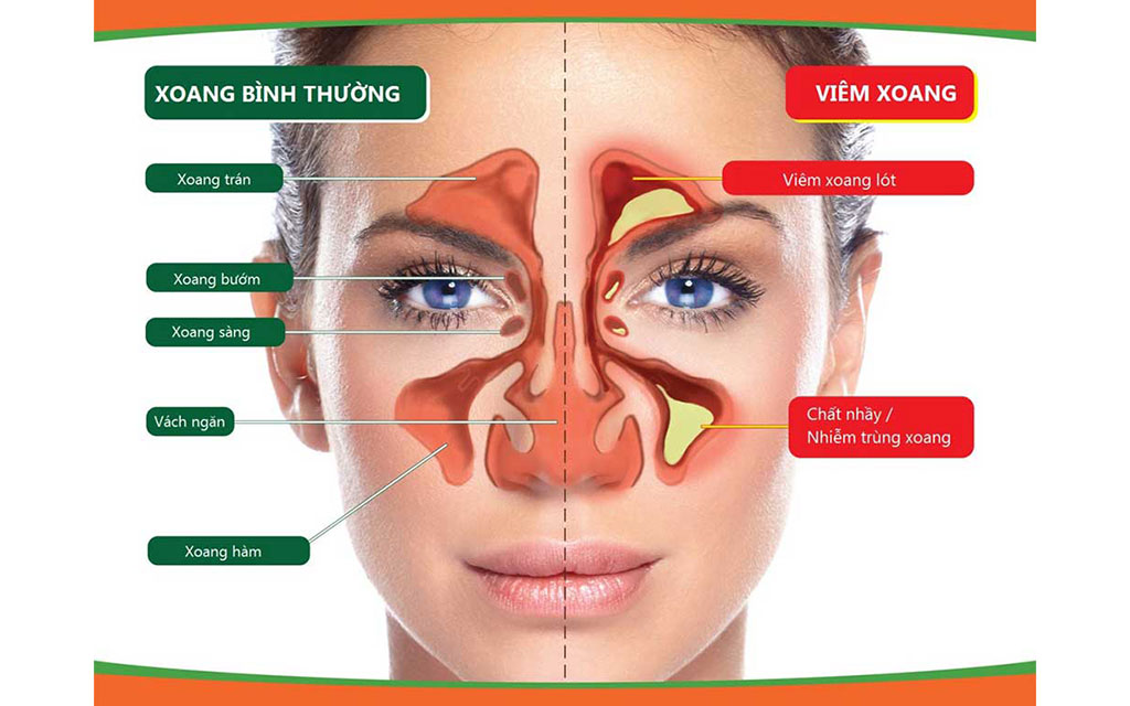 Hình ảnh viêm xoang cấp