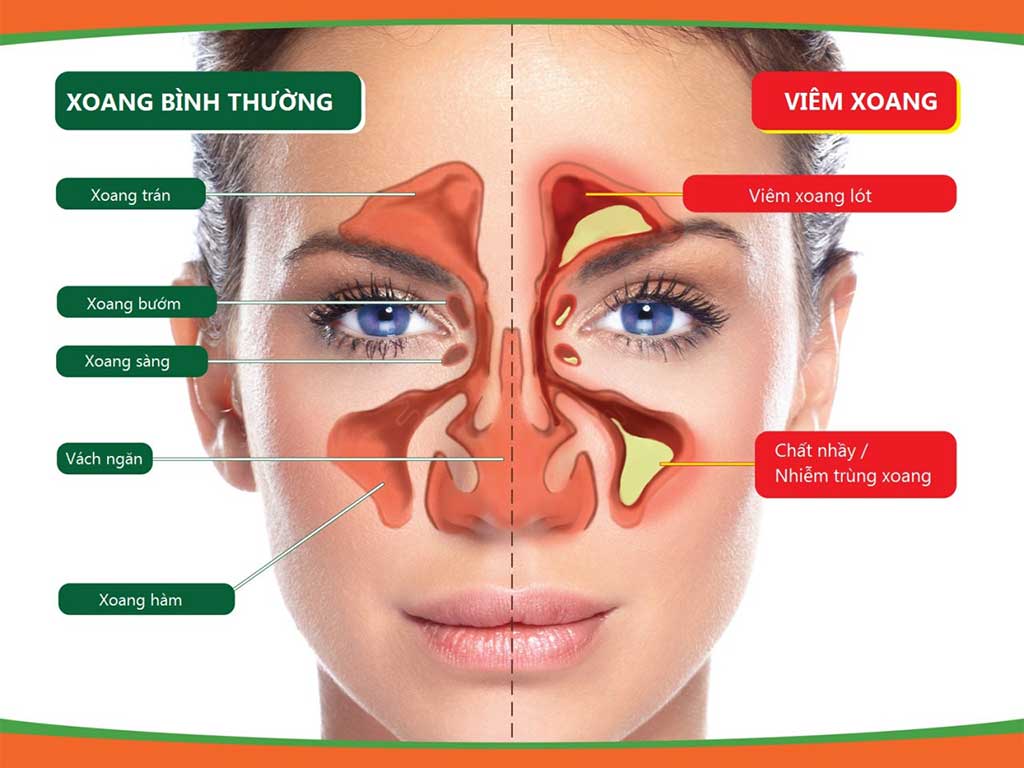 Cấu trúc xoang hàm viêm
